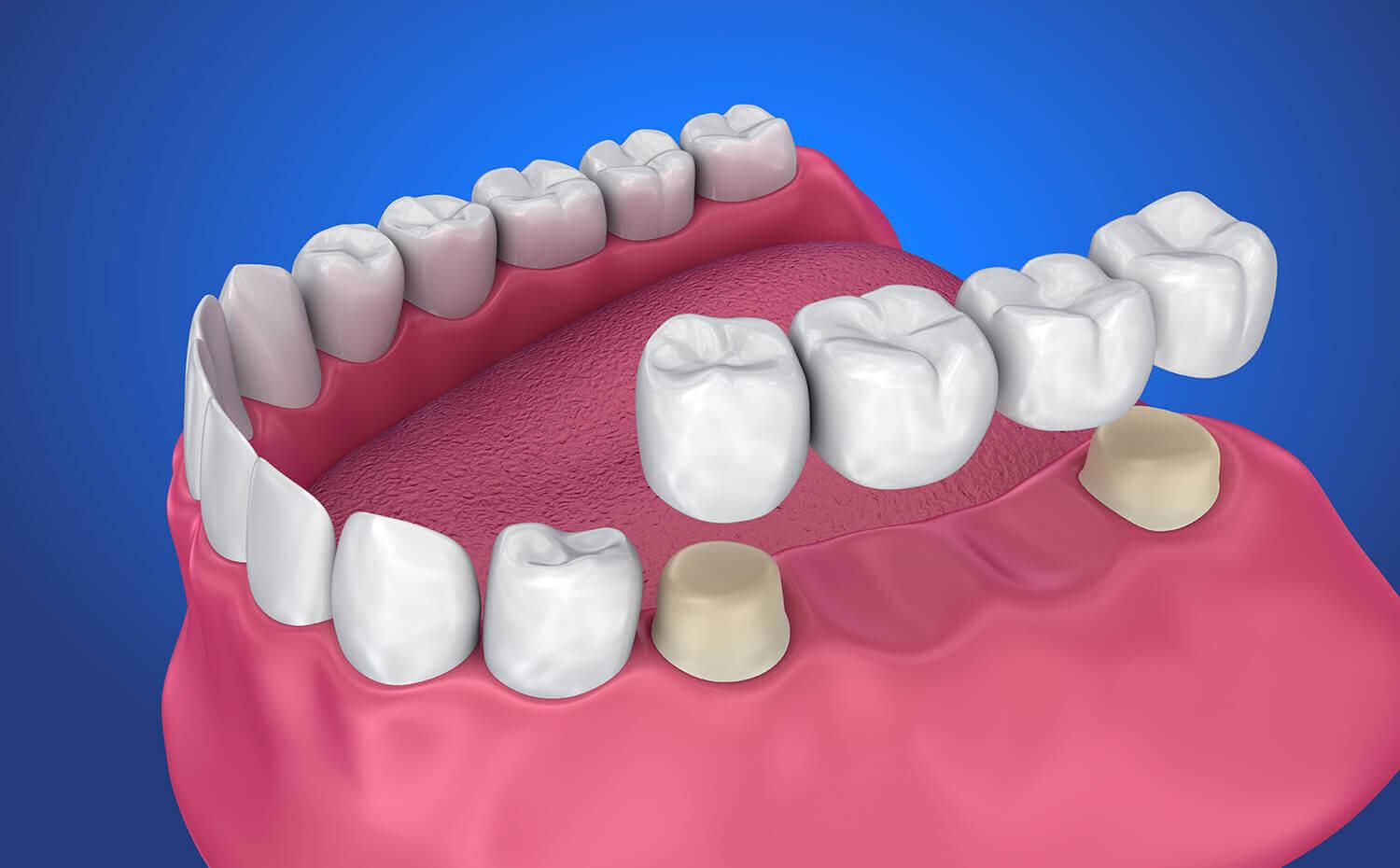 A dental crown and bridge