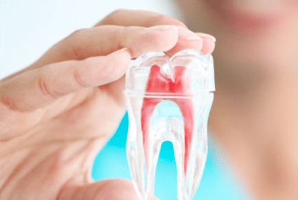 Root canal treatment illustration