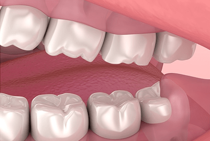 Wisdom Teeth Extraction